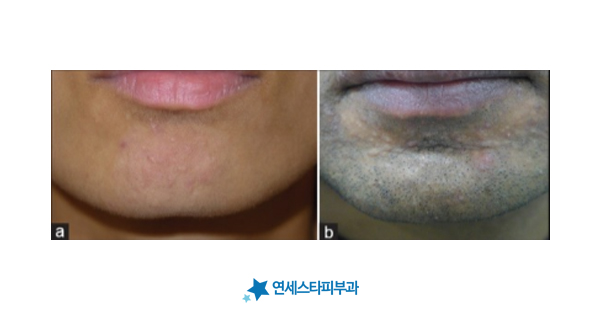 레이저 치료 방식을 설명하는 이미지