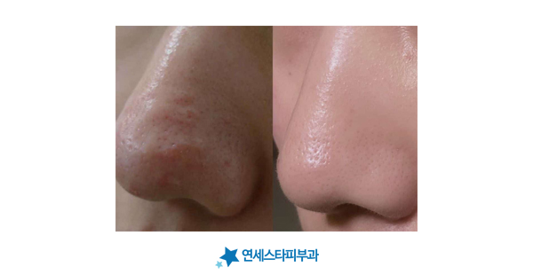 여드름이 넓은 연령층에서 발생함을 설명하는 이미지