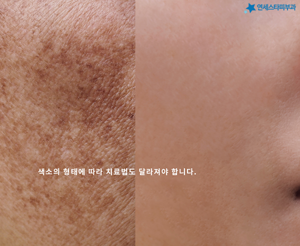 리팟레이저의 기술 원리를 설명하는 이미지