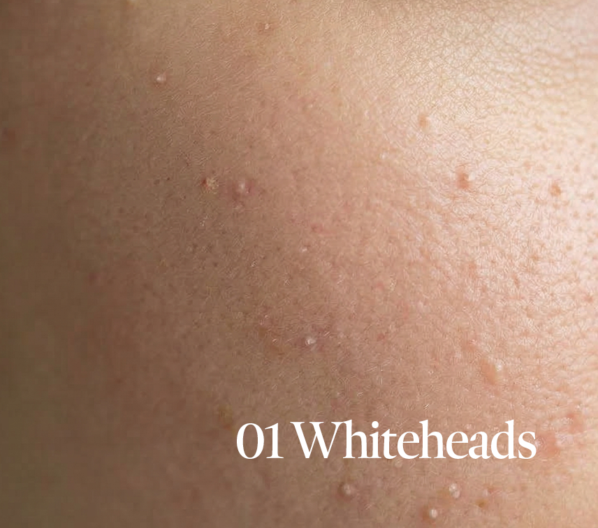 Whiteheads