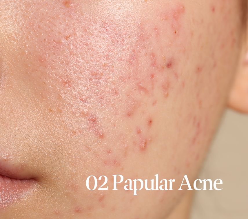 Papules