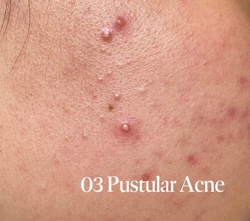 Pustules