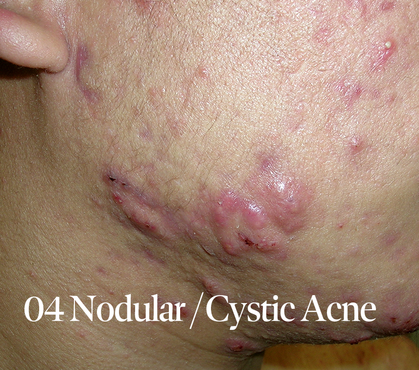Nodular / Cystic